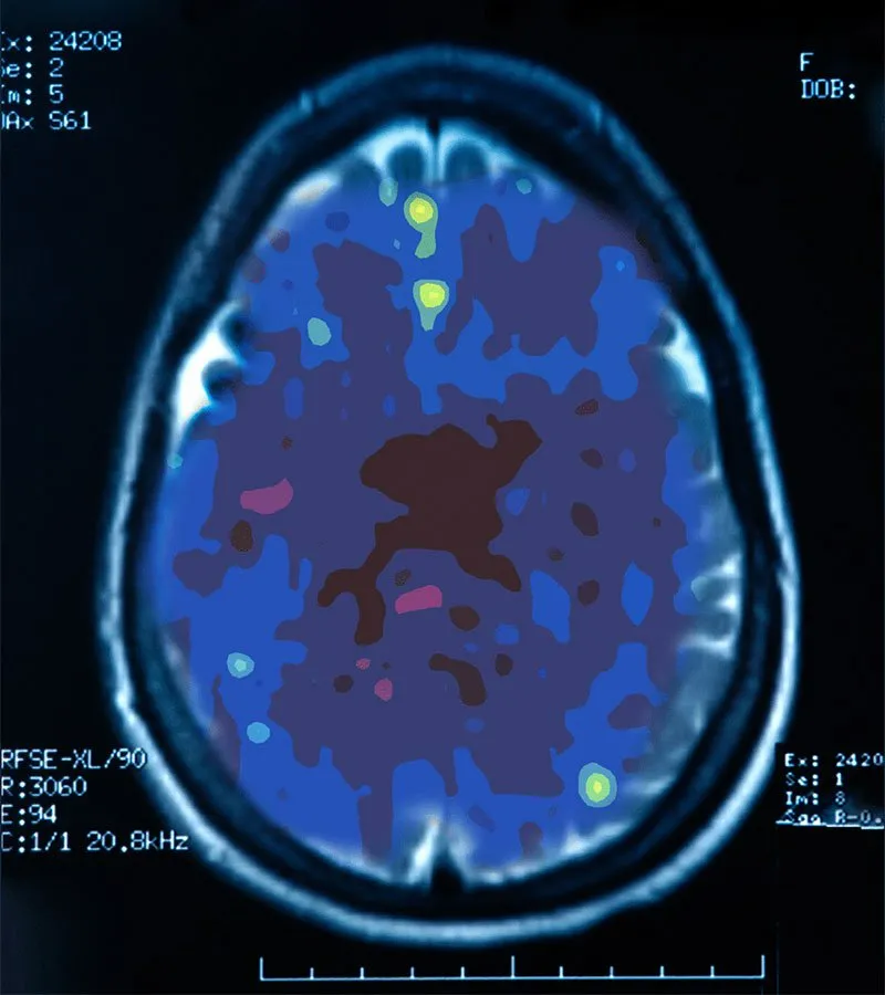 Colour-coded brain scan image